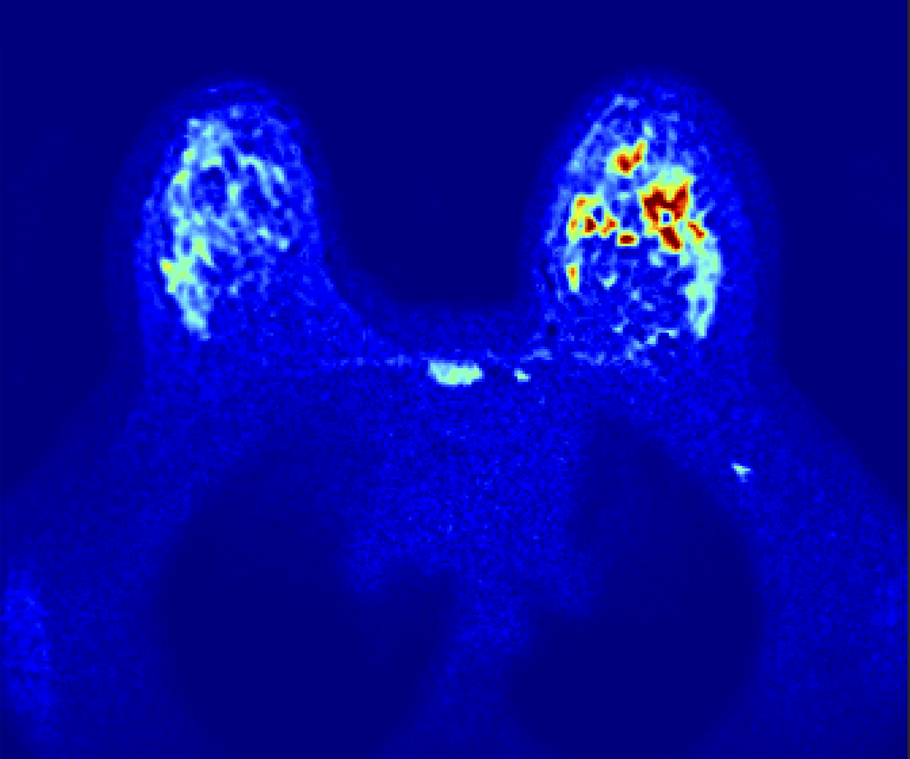 MRI Breast Cancer